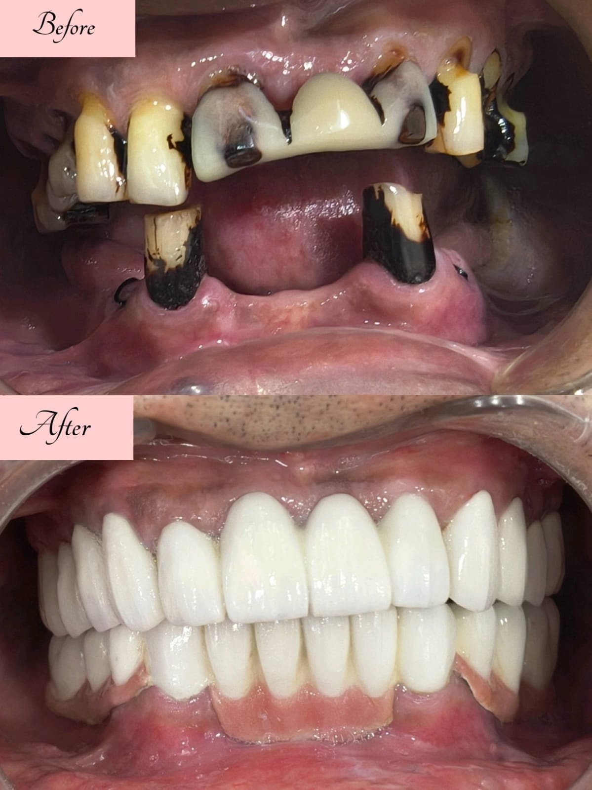 Clinical Case 14 - Clear Aligners