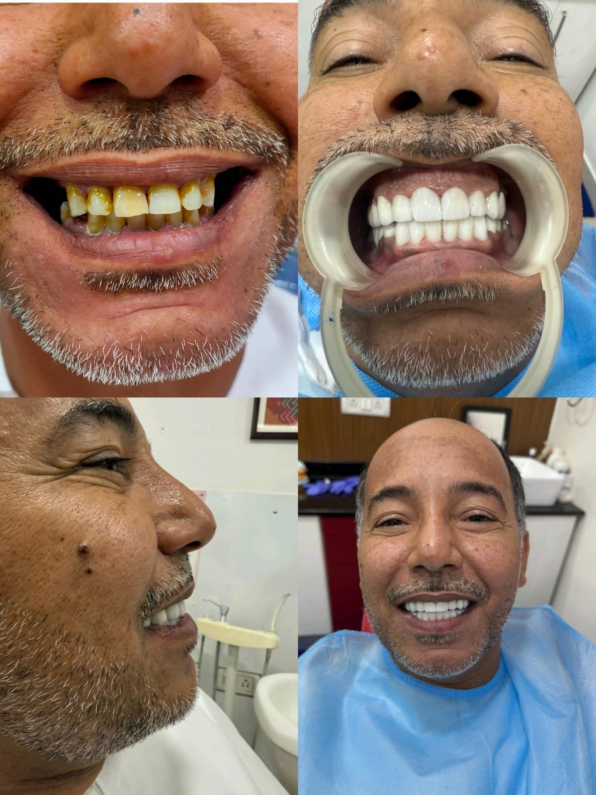 Clinical Case 17 - Total Smile Transformation